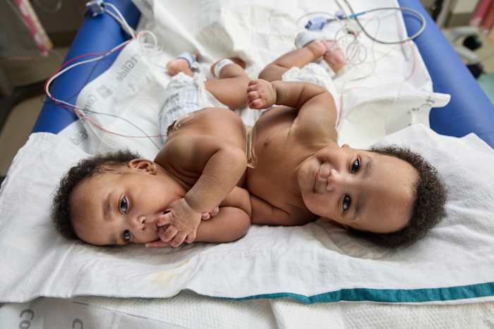 Deze foto, verstrekt door het Childrens Hospital of Philadelphia, toont de Siamese tweeling, Amari en Javar Ruffin, in het Childrens Hospital of Philadelphia, 20 maart 2024. (Ed Cunicelli/Childrens Hospital of Philadelphia via AP)