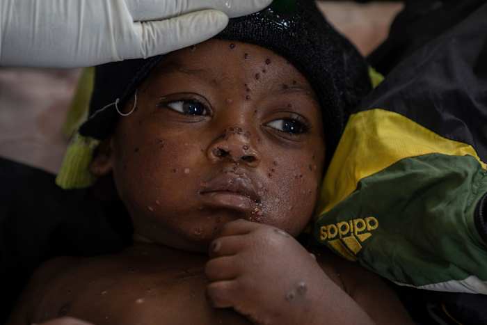 De VN geeft toestemming voor het eerste mpox-vaccin voor kinderen in een poging de uitbraak van Congo onder controle te krijgen