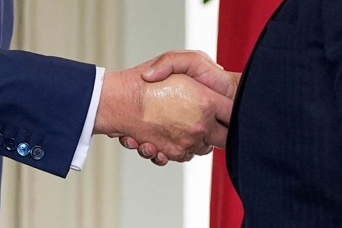 Trump wordt gecontroleerd op zwelling van de onderbeen en gediagnosticeerd met een gemeenschappelijke aandoening bij oudere volwassenen