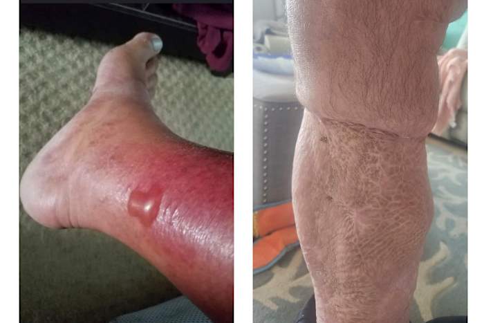 Hoe u uzelf kunt beschermen tegen Vibrio vulnificus, de bacteriën die in sommige kustwateren zijn gevonden