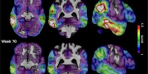 Een experimenteel Alzheimer-medicijn toont belofte dat het zich richt op een ander herseneiwit, blijkt uit een nieuwe studie