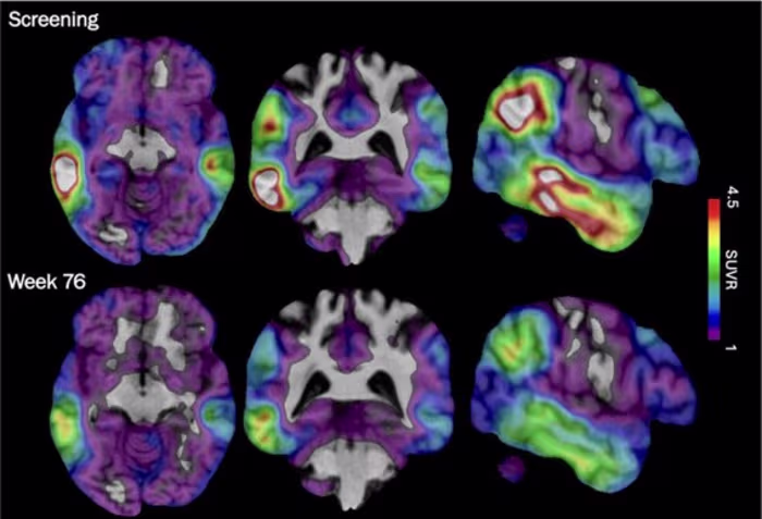 Een experimenteel Alzheimer-medicijn toont belofte dat het zich richt op een ander herseneiwit, blijkt uit een nieuwe studie